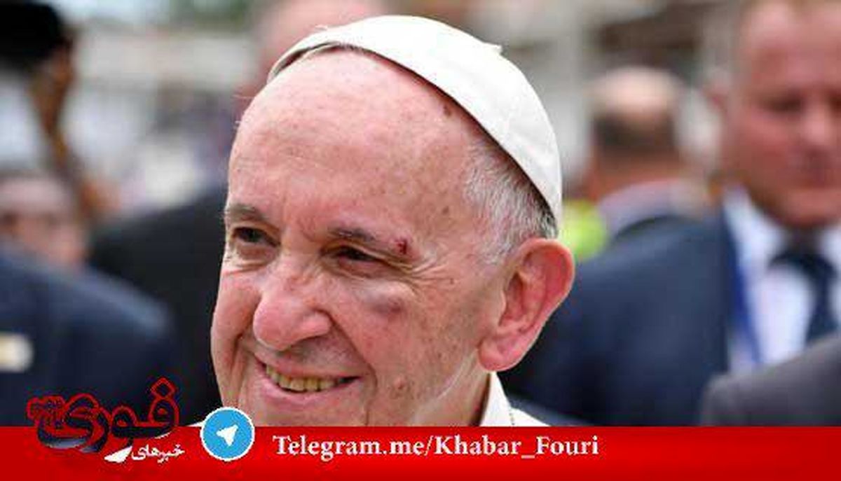 پاپ هنگام سوار شدن بر خودرویش مجروح شد +عکس