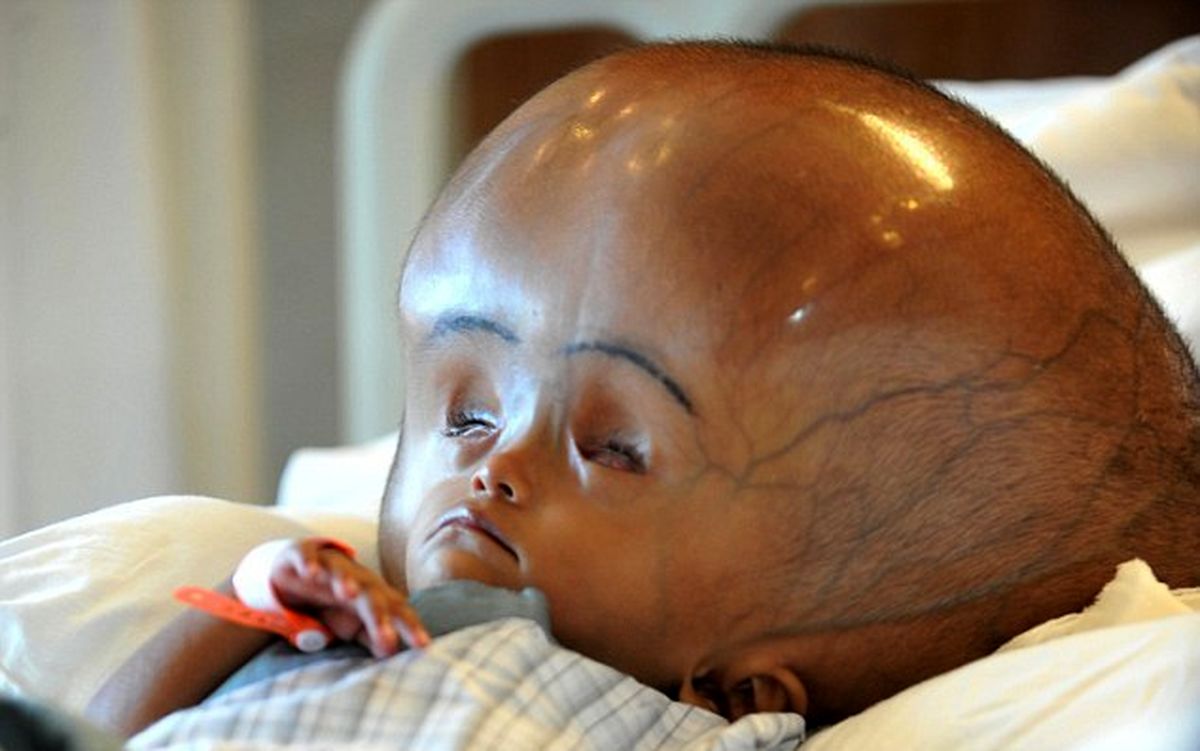 بزرگترین سر دنیا کوچک شد/تصاویر