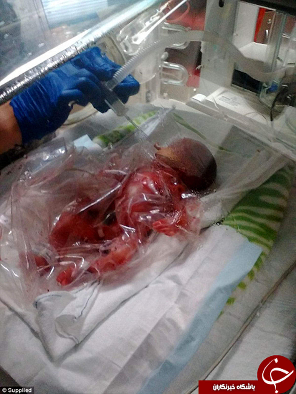 زنده ماندن عجیب بچه‌ای که ۳ ماهه بدنیا آمد +تصاویر