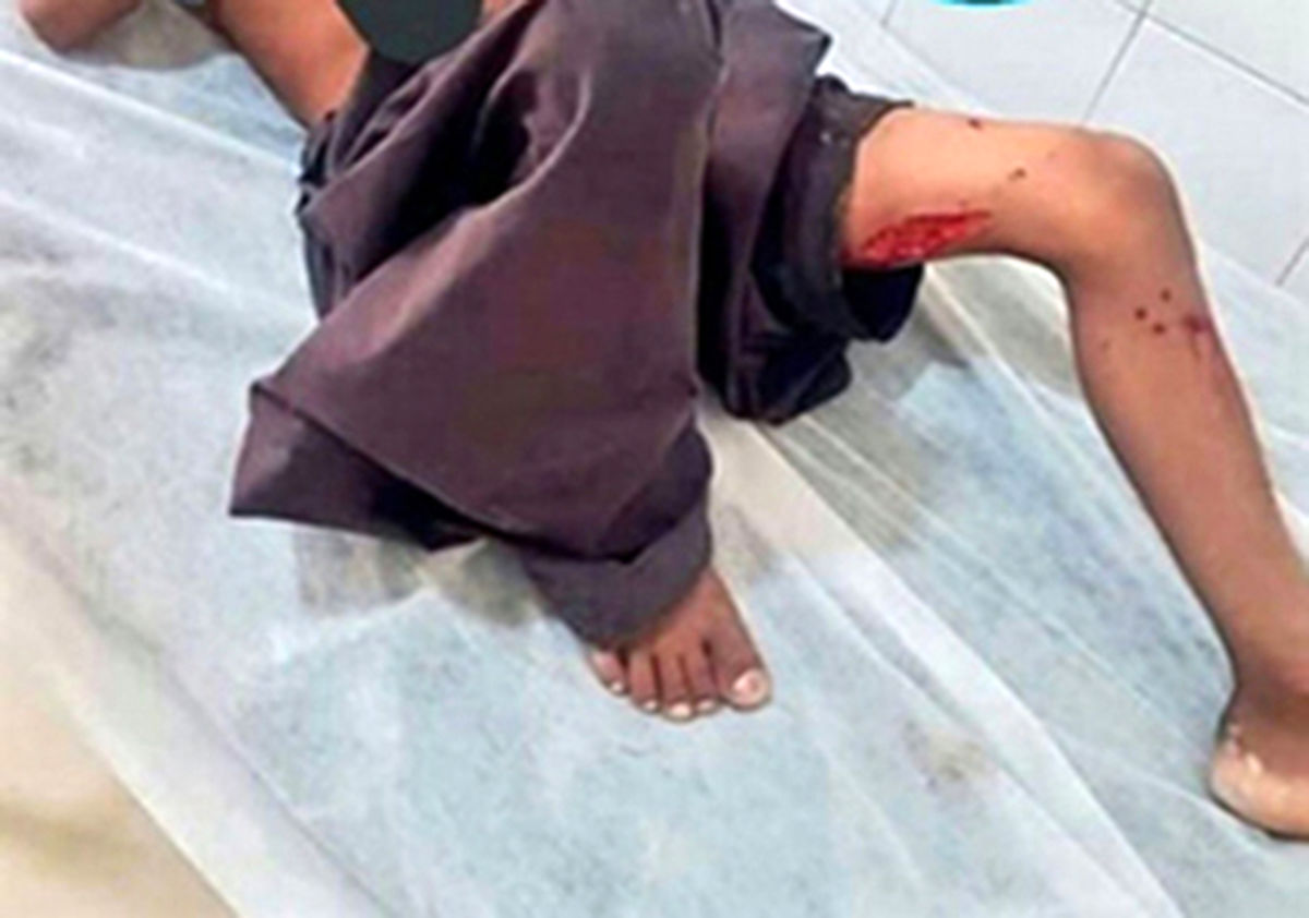 ​حمله مجدد گاندوها به یک‌کودک در چابهار +عکس