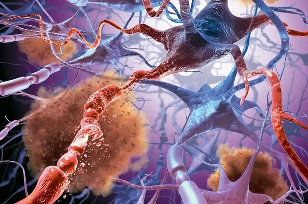 چرا مبتلایان به سندرم داون زودتر آلزایمر می‌گیرند؟