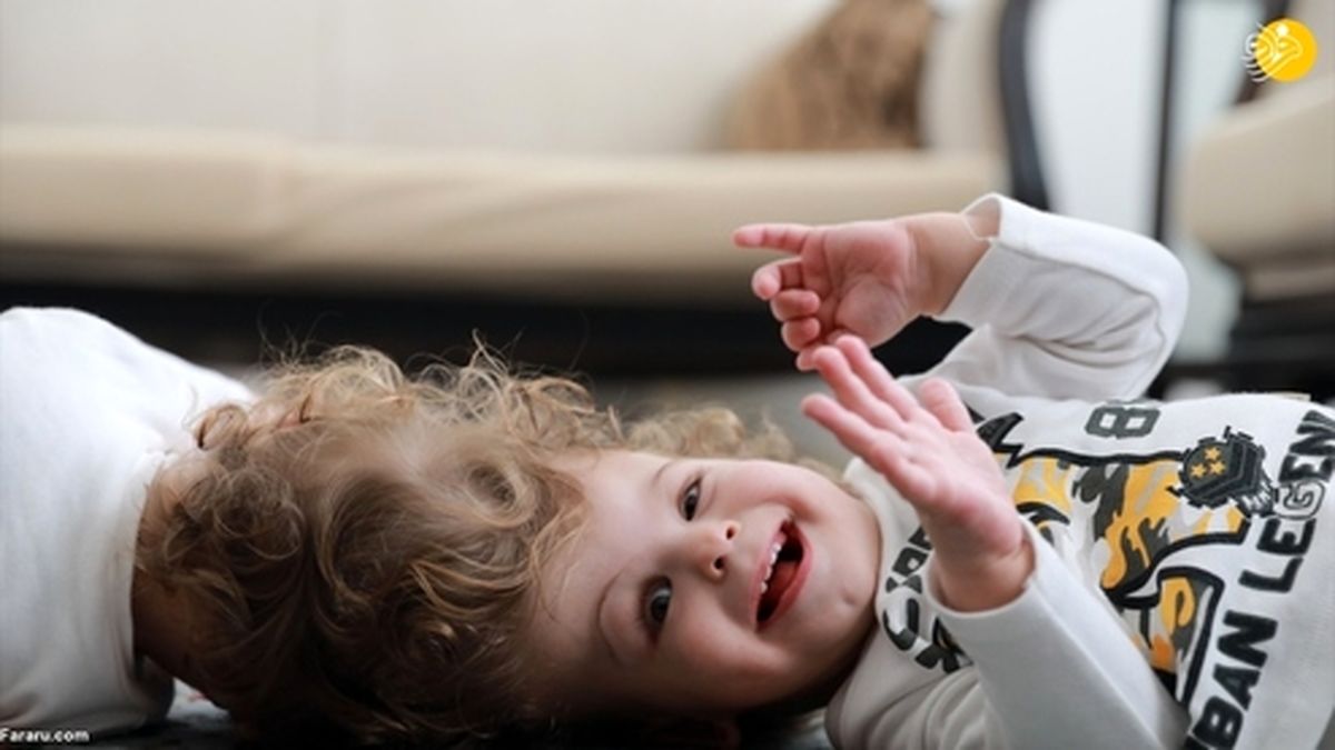 تصاویر: جداسازی دوقلوهای به هم چسبیده از سر