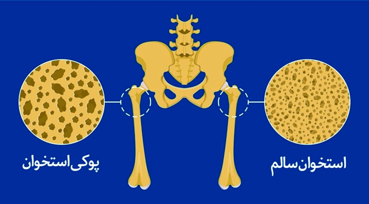 چگونه از پوکی استخوان در امان بمانیم؟