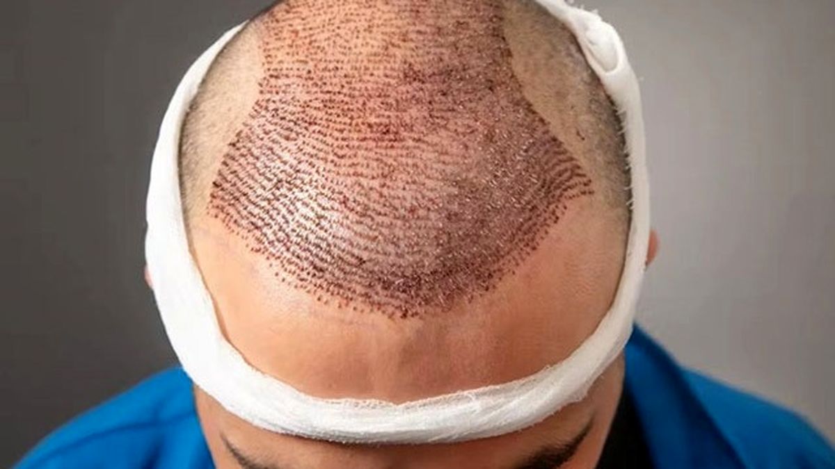 کاشت مو چیست؟ چگونه انجام می‌شود؟