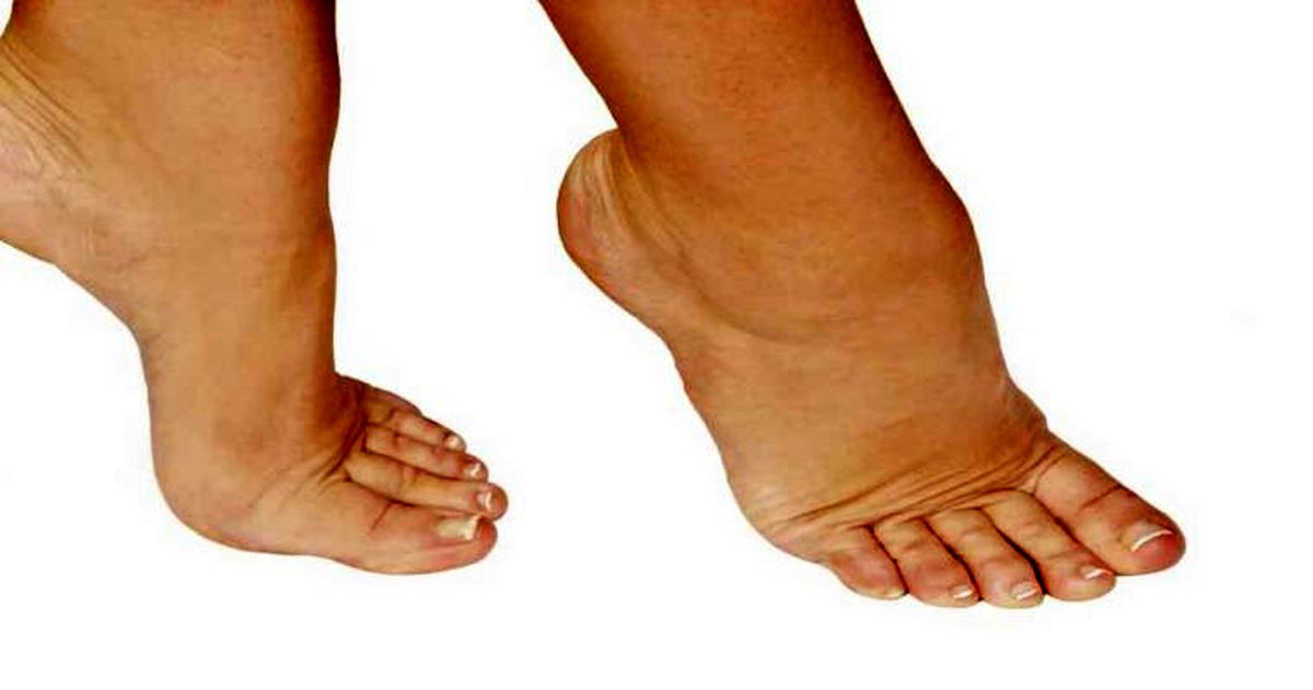 ۵ دلیل ورم پا که باید جدی بگیرید