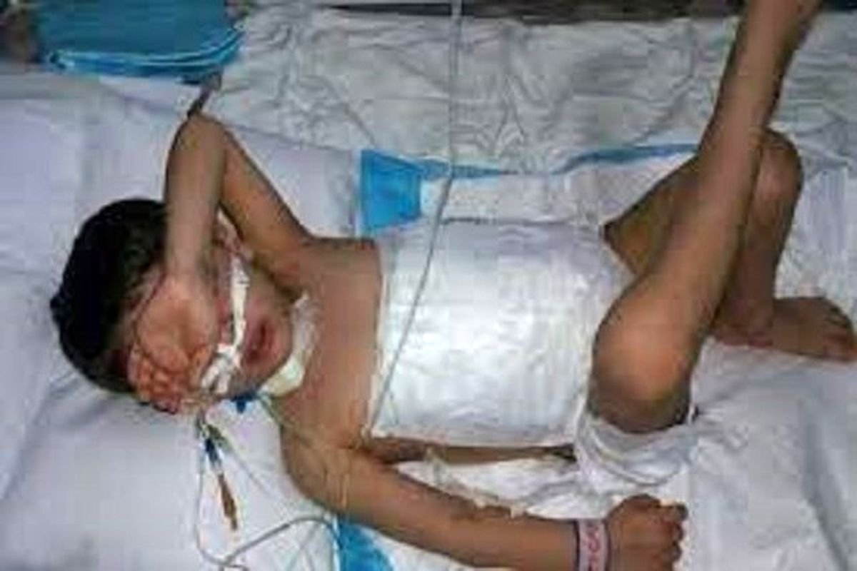 فوت کودک ۵ ساله که توسط سگ دریده شده بود