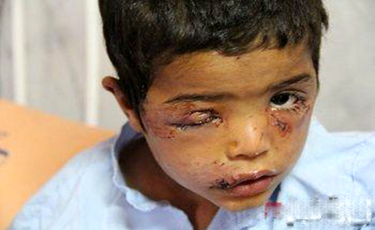 حمله سگ ولگرد به کودک ۳ ساله +عکس