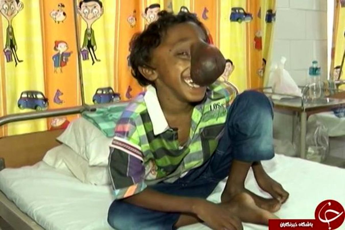 تصاویر عجیب و دردناک از پسر بچه فیل نما!