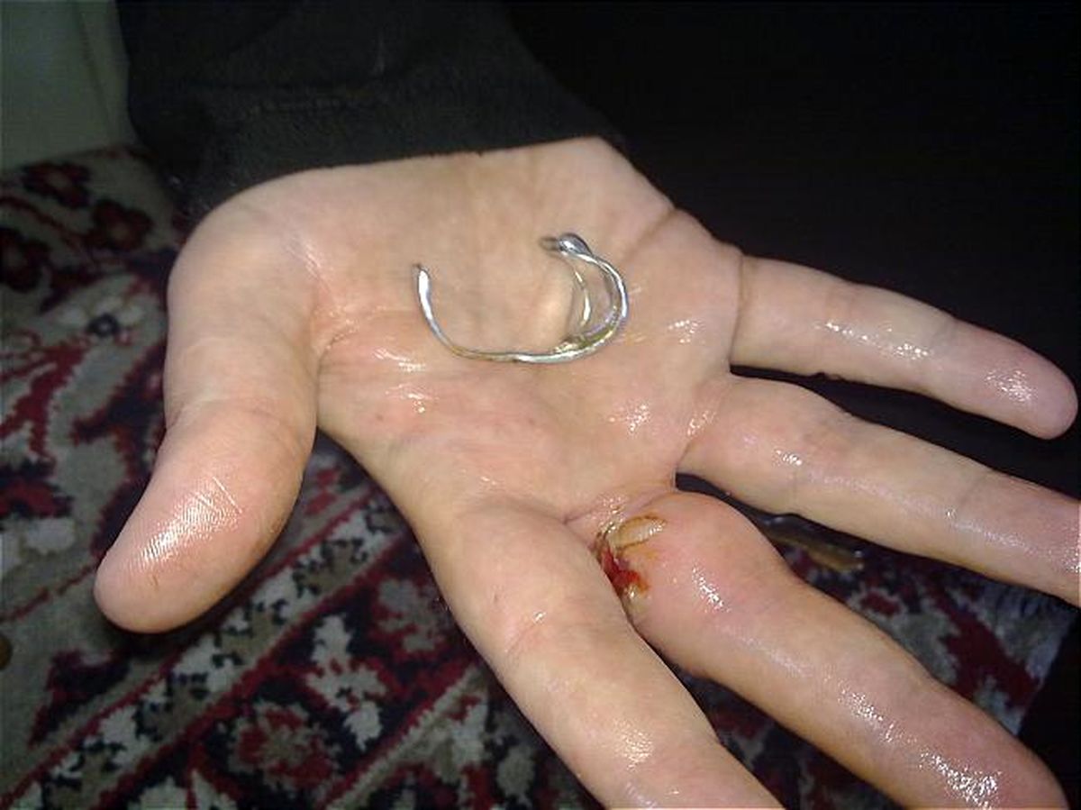انگشتری که دردسرساز شد/عکس